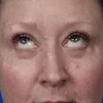 Lower Blepharoplasty Before & After Patient #5228