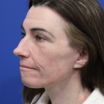 Brow Lift Before & After Patient #5226