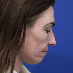 Facelift Before & After Patient #5227