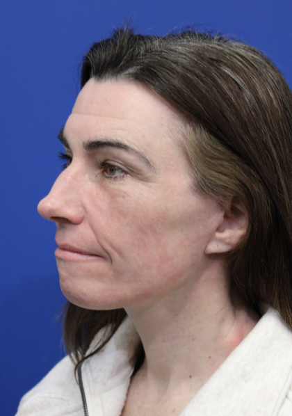 Laser Resurfacing Before & After Patient #5225