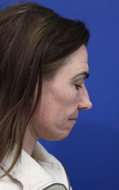 Facelift Before & After Patient #5227
