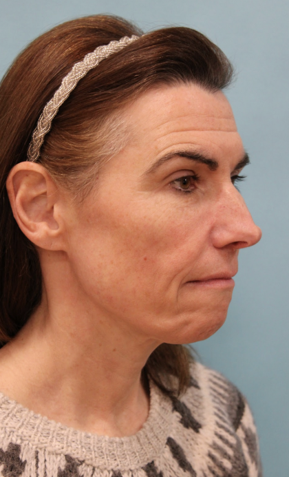 Facelift Before & After Patient #5227