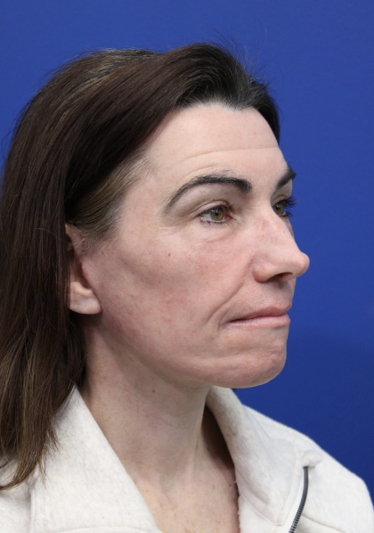 Facelift Before & After Patient #5227
