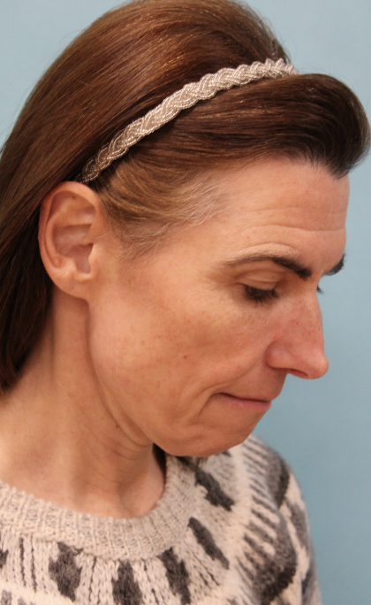 Facelift Before & After Patient #5227