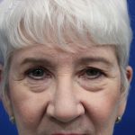 Upper Blepharoplasty Before & After Patient #5470
