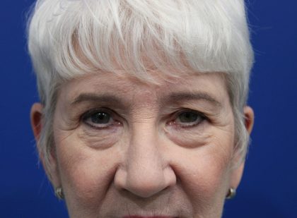 Upper Blepharoplasty Before & After Patient #5470