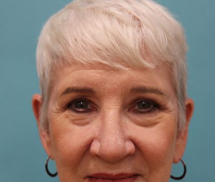 Upper Blepharoplasty Before & After Patient #5470