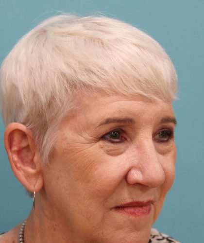 Upper Blepharoplasty Before & After Patient #5470