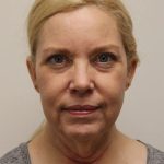 Facelift Before & After Patient #5277