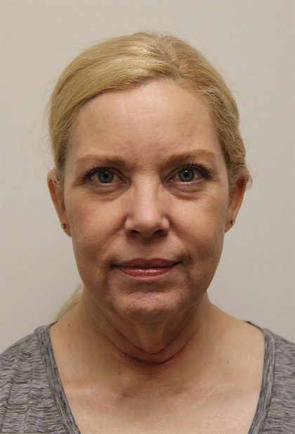 Facelift Before & After Patient #5277