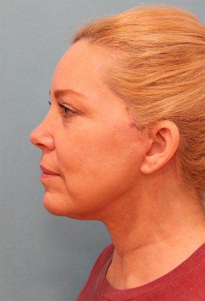 Facelift Before & After Patient #5277