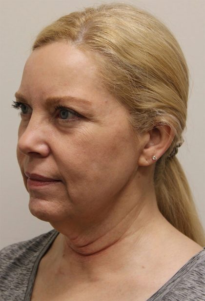 Facelift Before & After Patient #5277
