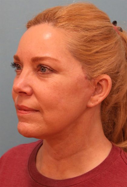 Facelift Before & After Patient #5277