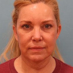 Facelift Before & After Patient #5277