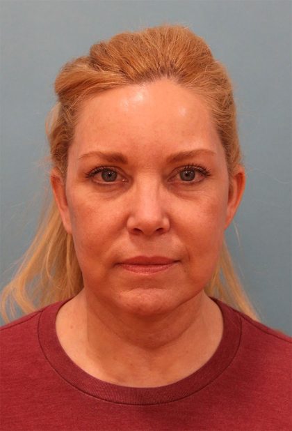 Facelift Before & After Patient #5277