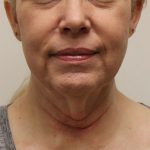Facelift Before & After Patient #5277