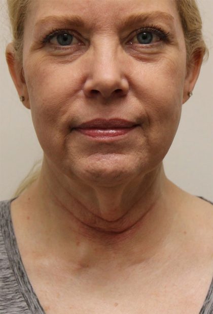 Facelift Before & After Patient #5277