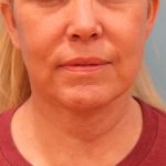 Facelift Before & After Patient #5277