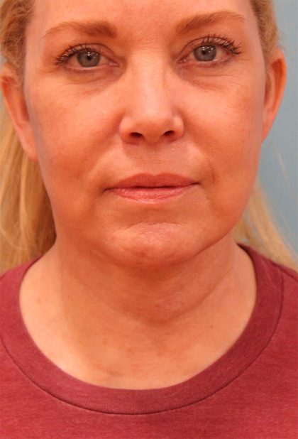 Facelift Before & After Patient #5277