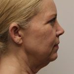 Facelift Before & After Patient #5277
