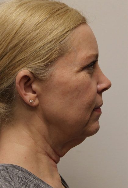 Facelift Before & After Patient #5277