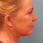 Facelift Before & After Patient #5277