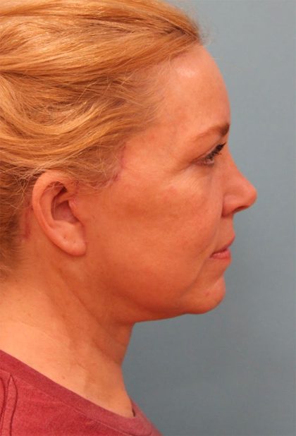 Facelift Before & After Patient #5277