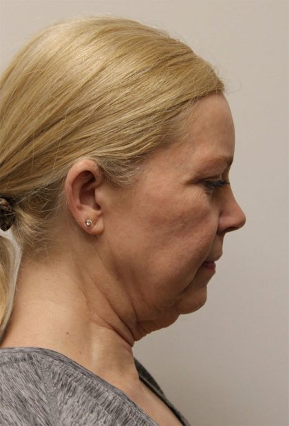 Facelift Before & After Patient #5277