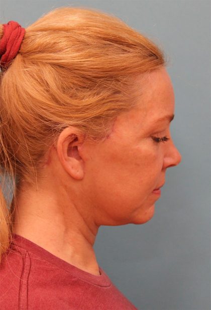Facelift Before & After Patient #5277
