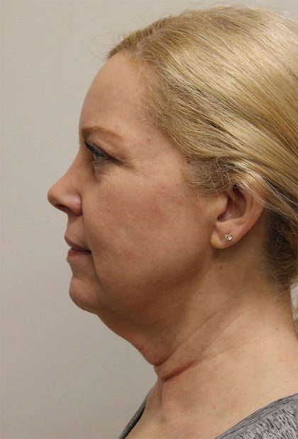Facelift Before & After Patient #5277