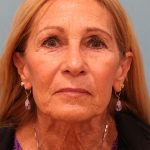 Facelift Before & After Patient #5278