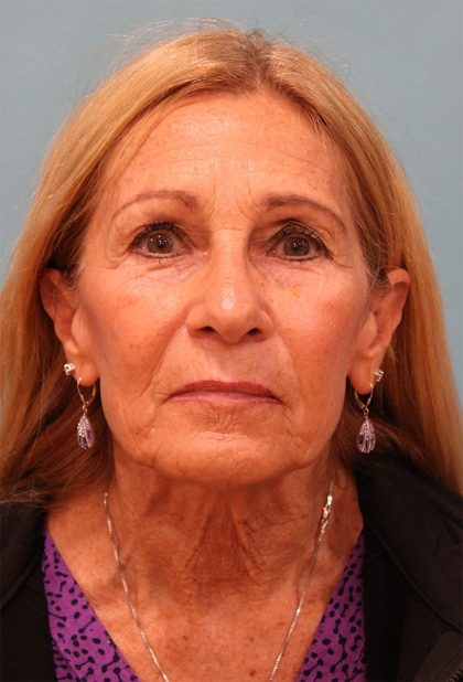 Facelift Before & After Patient #5278