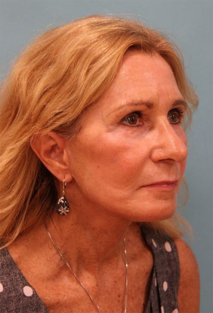 Facelift Before & After Patient #5278
