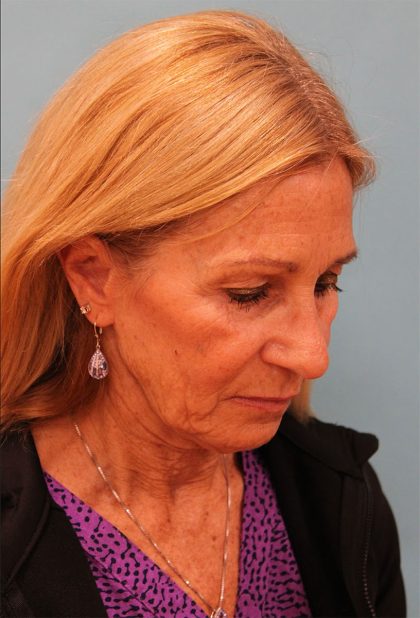 Facelift Before & After Patient #5278