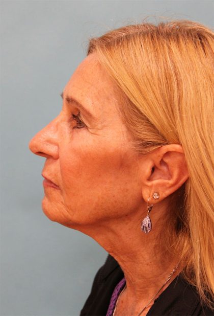 Facelift Before & After Patient #5278