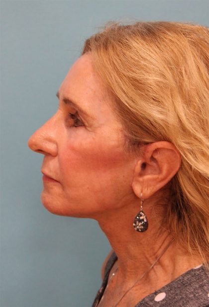 Facelift Before & After Patient #5278