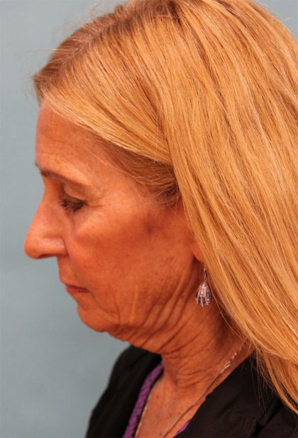 Facelift Before & After Patient #5278