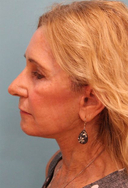 Facelift Before & After Patient #5278