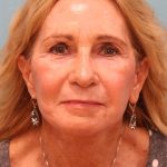 Facelift Before & After Patient #5278