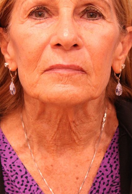 Facelift Before & After Patient #5278