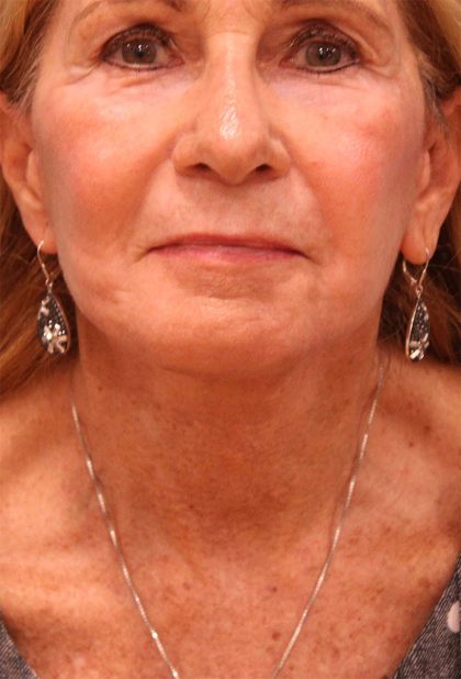 Facelift Before & After Patient #5278
