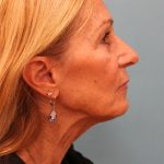 Facelift Before & After Patient #5278