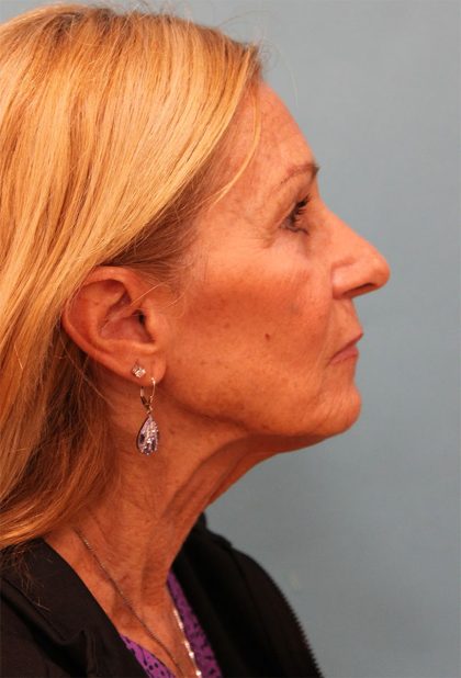Facelift Before & After Patient #5278