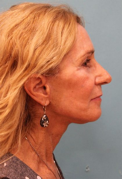 Facelift Before & After Patient #5278