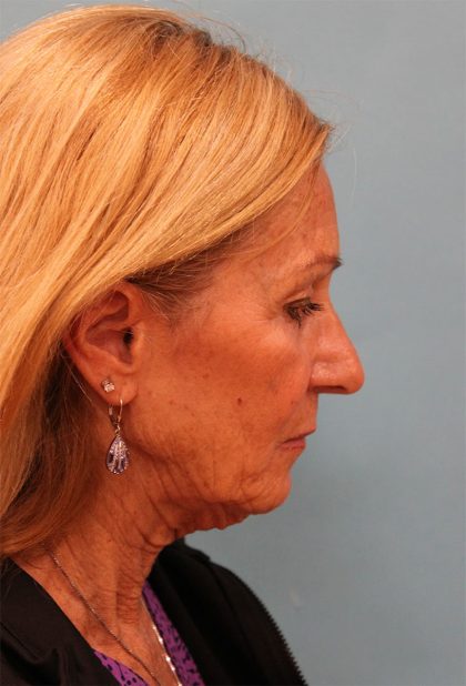 Facelift Before & After Patient #5278