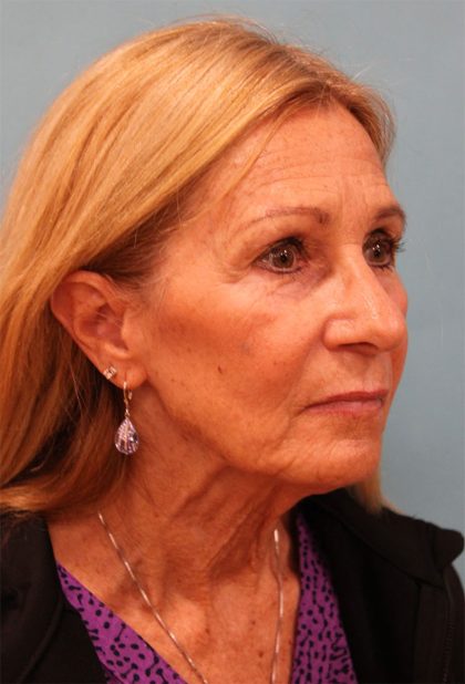 Facelift Before & After Patient #5278