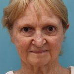 Facelift Before & After Patient #5279