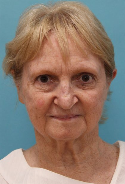 Facelift Before & After Patient #5279