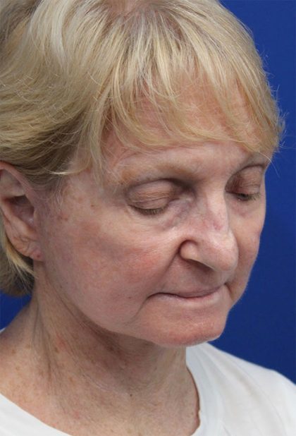 Facelift Before & After Patient #5279