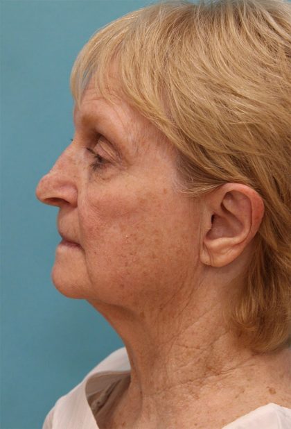 Facelift Before & After Patient #5279